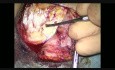 Implantation of the BAHA Attract Subcutaneous Bone Conduction Auditory Implant