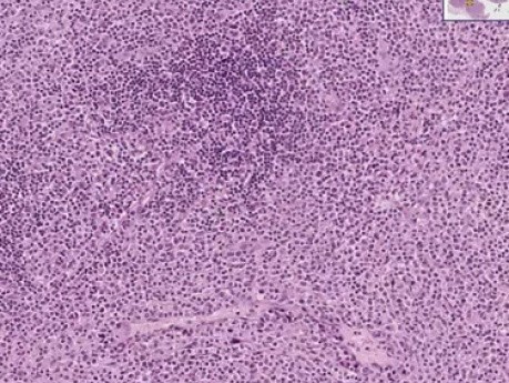 Peripheral T-cell lymphoma - Histopathology - Lymph node