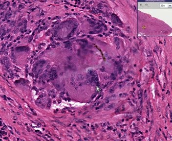 Soft Tissue - Foreign Body Reaction