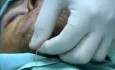 Chin augmentation without Scars