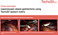 Laparoscopic Sleeve Gastrectomy Using TachoSil® Sealant Matrix, Johannes Heimbucher