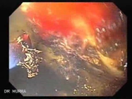 Gastrointestinal Bleeding Caused by Advanced Gastric Carcinoma - Suspected Vessel