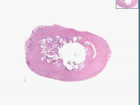 Onchocerca volvulus
