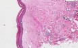 Lichen sclerosus et atrophicus - Histology