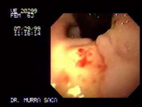 Esophageal Ulcer Due To GERD