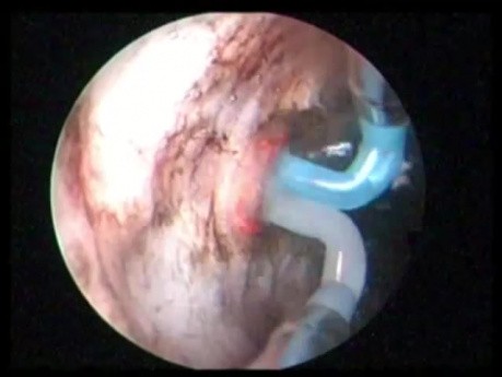 Transurethral Plasma Vaporization Of The Prostate In Saline Water