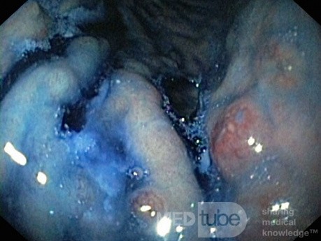 Unusual Appearance of Fundic Polyps. Chromoendoscopy. NET (4/6)