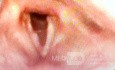 Cancer of the Right Vocal Fold