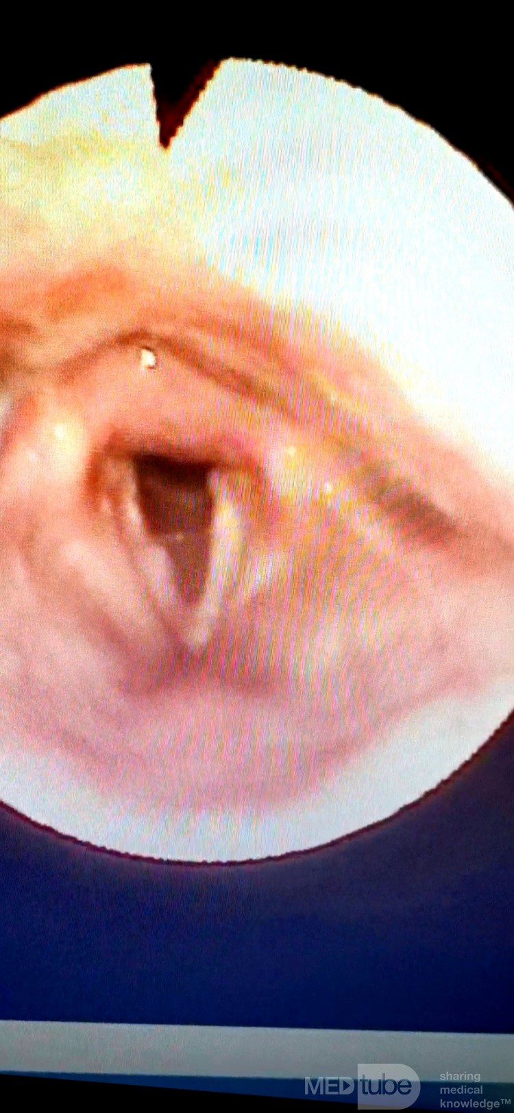 Cancer of the Right Vocal Fold