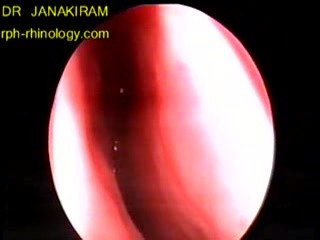 Epistaxis Due To Anterior Ethmoidal Artery