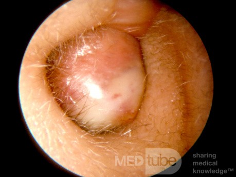 Total  Stenosis of the External Canal with Entrapped Keratin