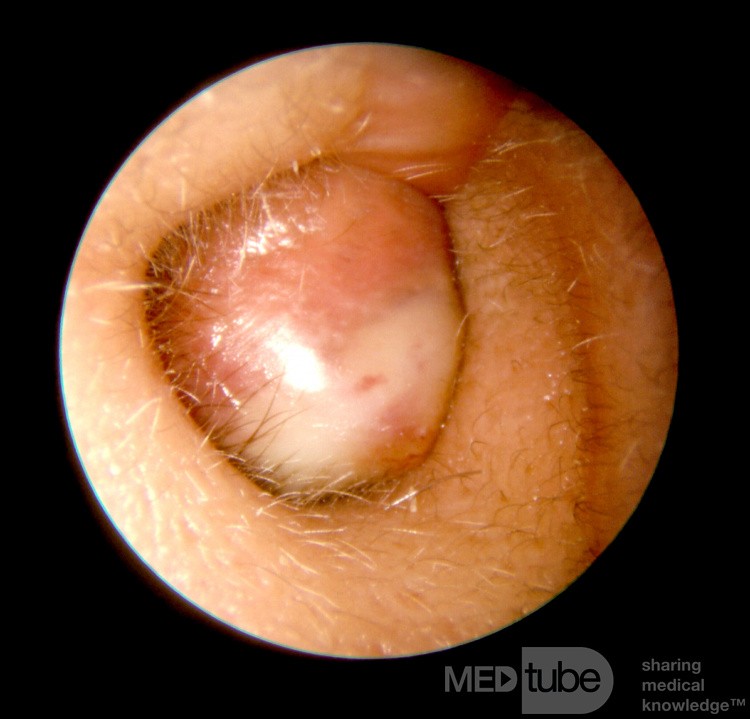 Total  Stenosis of the External Canal with Entrapped Keratin
