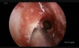 Treatment of a Fungal Ball in the Sphenoid Sinus