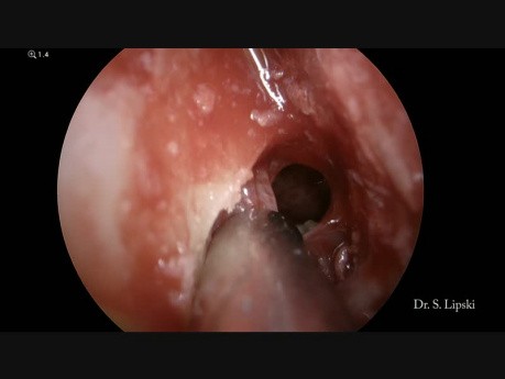 Treatment of a Fungal Ball in the Sphenoid Sinus