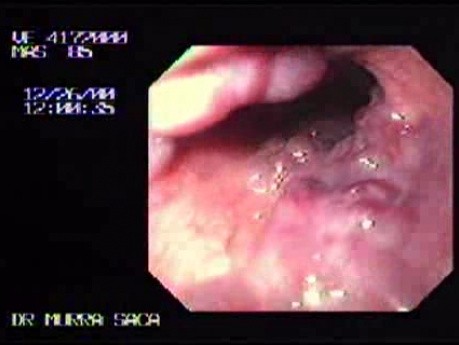 Alcoholic Cirrhosis as a Cause of Esophageal Varices