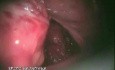 Laparoscopic Anterior Resection Of Rectum