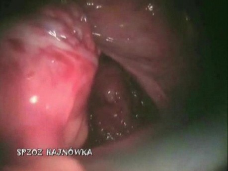 Laparoscopic Anterior Resection Of Rectum