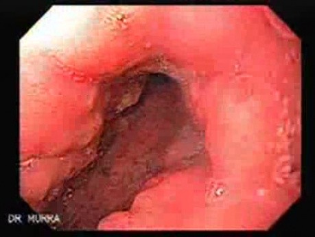 Scirrhous Gastric Carcinoma - Endoscopy (3 of 47)