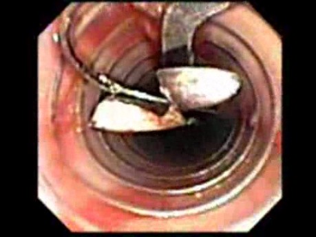 Modified Needle Holder For Gastroplicature - Endoscopic View