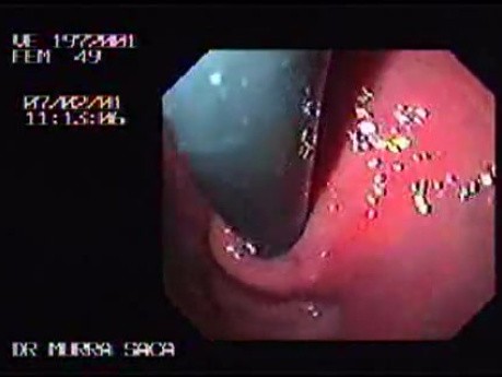 Esophageal Achalasia (7 of 7)
