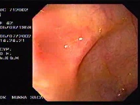 Crohn's Disease - Endoscopy (17 of 28)