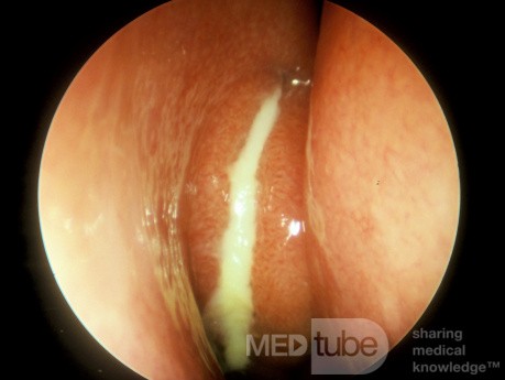 Recurrent Acute Maxillary Sinusitis [right]