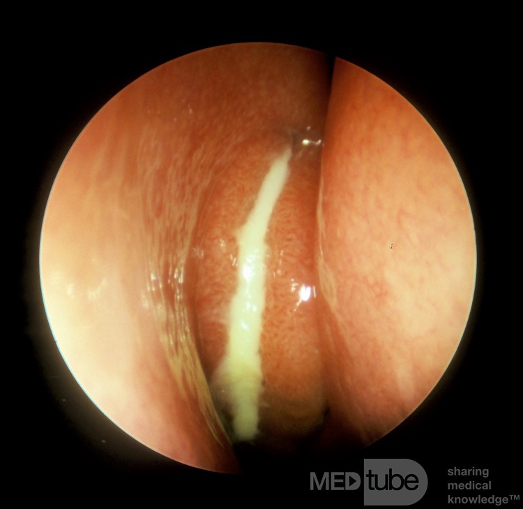Recurrent Acute Maxillary Sinusitis [right]