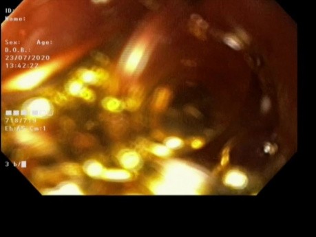 Endoscopic Removal of Safety Pin