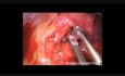 Left Paratracheal and Subaortic Lymph Node Dissection by Uniportal VATS