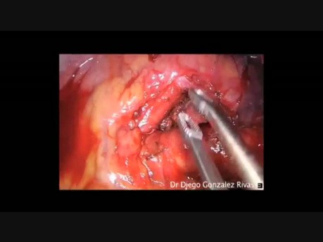 Left Paratracheal and Subaortic Lymph Node Dissection by Uniportal VATS