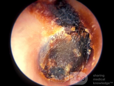 Deeply Impacted Cerumen With Cotton Tipped Applicator Impression
