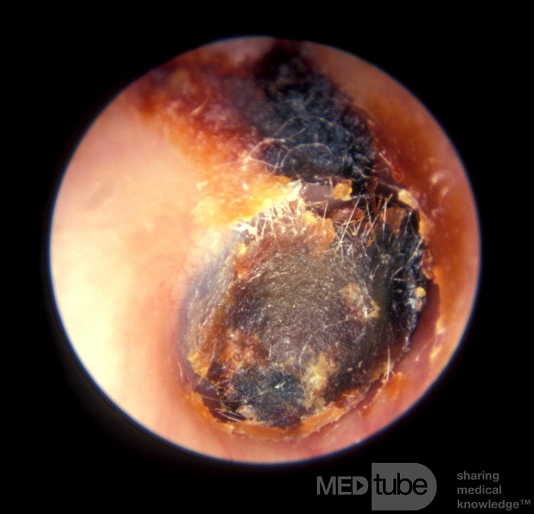 Deeply Impacted Cerumen With Cotton Tipped Applicator Impression
