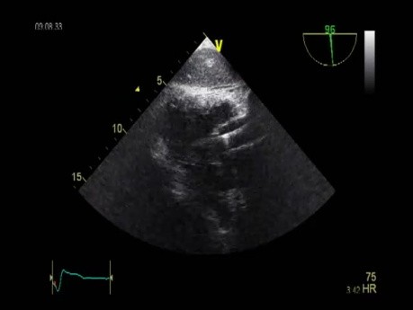 Echocardiography - Transgastric View