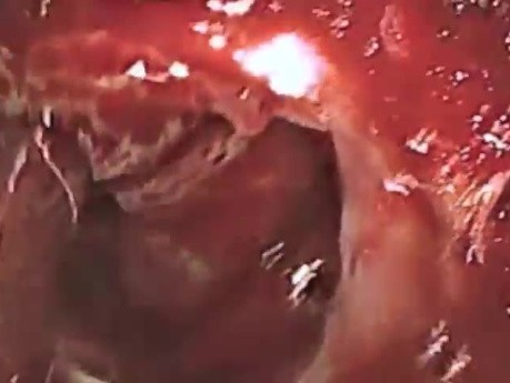 Endoscopic Removal of Pituitary Macroadenoma with Visual Loss