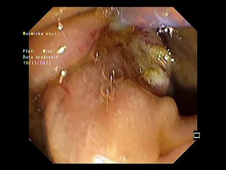Sphincterotomy - How Far is Enough, ERCP Stone Extraction