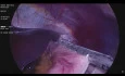 Sleeve Gastrectomy Surgery (3 Keyhole, Double Layer, Stitch Technique)