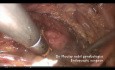 Rare case: Obstructed Hemivagina, Renal Agenesis, Septate Uterus