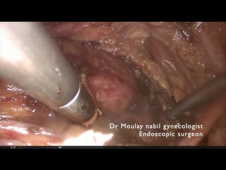 Rare case: Obstructed Hemivagina, Renal Agenesis, Septate Uterus