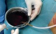 Primary Palmar Hyperhidrosis: Thoracoscopic Sympatholysis
