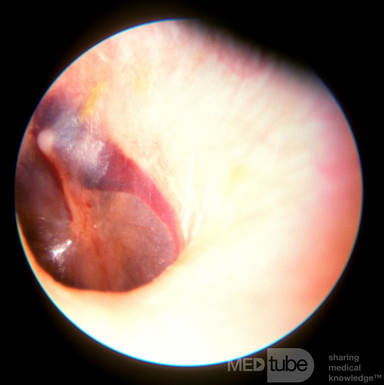 Middle Ear Barotrauma