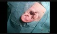 Preauricular Apendix Removal