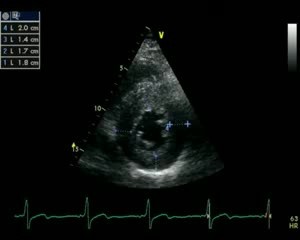 Hypertrophic Cardiomyopathy