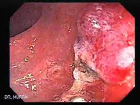Endoscopic Appearance of Pedicled Polyp of the Descending Colon (7 of 7)