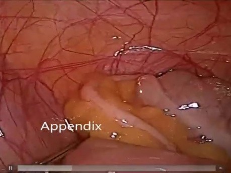 Diagnostic Laparoscopy Lecture