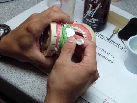 Anterior Bridge Preparation, Part 5 - Jet Provisional Fabrication - 1St Pass Before Reline