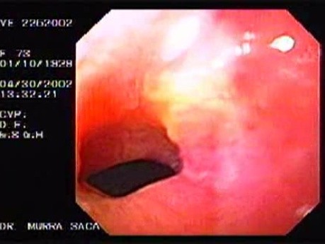 Gastric Adenocarcinoma With Signet Ring Cells - Endoscopy (1 of 4)
