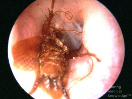 Foreign Body [Insect] External Ear Canal