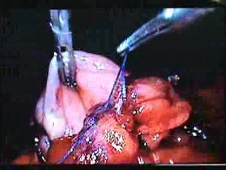 Jejunal Gastrointestinal Stromal tumor (GIST) (52 of 86)