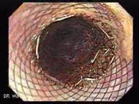 Placement Of The Esophageal Stent - 10/12