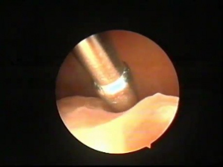 Excision of Uterine Polyps